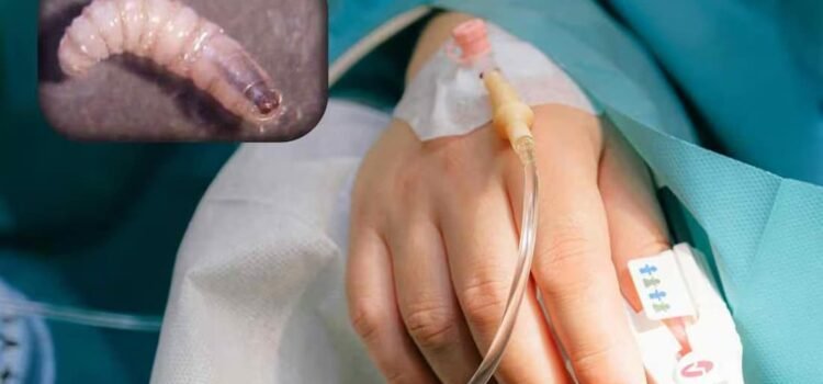 Reportan 15 casos de miasis humana en Chiapas