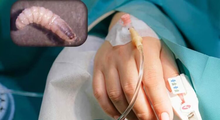 Reportan 15 casos de miasis humana en Chiapas